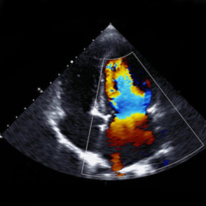 Doppler Study – (Upper Limb/Lower Limb)