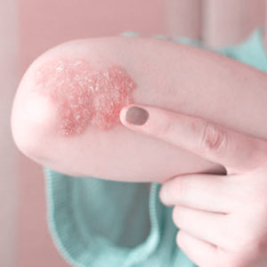 Psoriasis