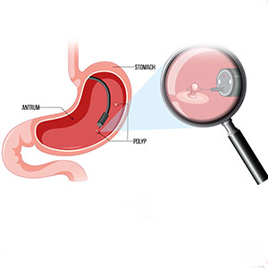 Upper-GI-Endoscopy